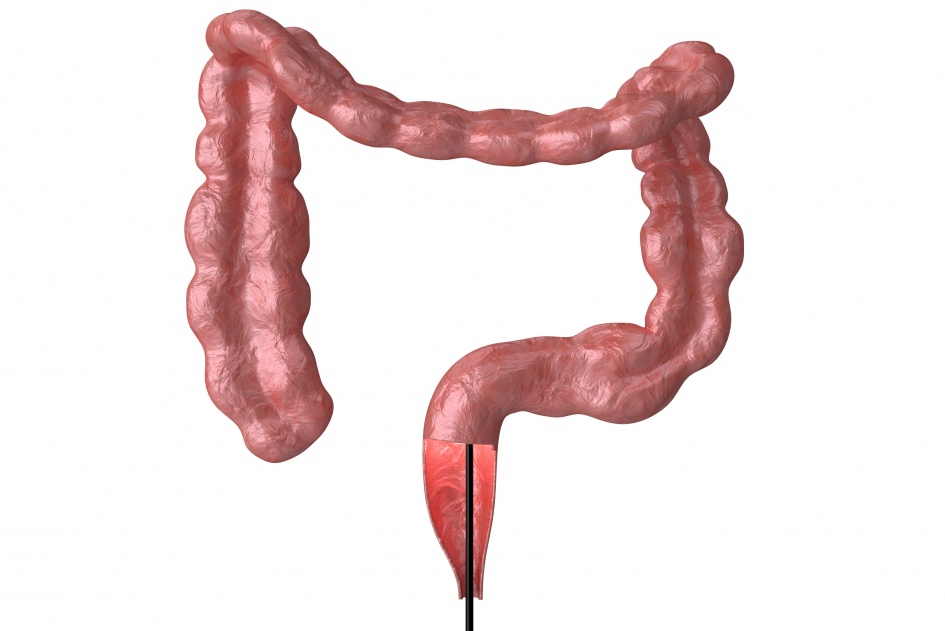 Tenho histórico familiar de pólipos intestinais. Devo adiantar a colonoscopia?